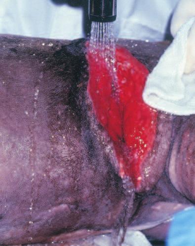 Compendium January 2002 Wound Management Sugar 43 lar sugar paste 5 used on wounds has been shown to reduce water available and inhibit bacterial growth; however, granulation tissue is still allowed