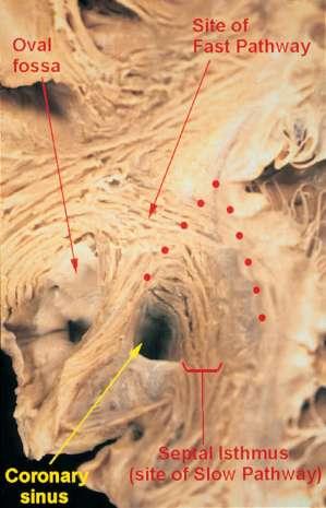 Atrio-Ventricular Node: Structure Significant areas of