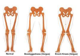 Varus and valgus in the knees and ankles: The difference between the ankles and knees excessively bending