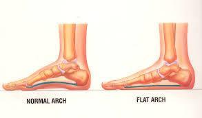 Flat foot: The foot has a small or no arch on the inside.