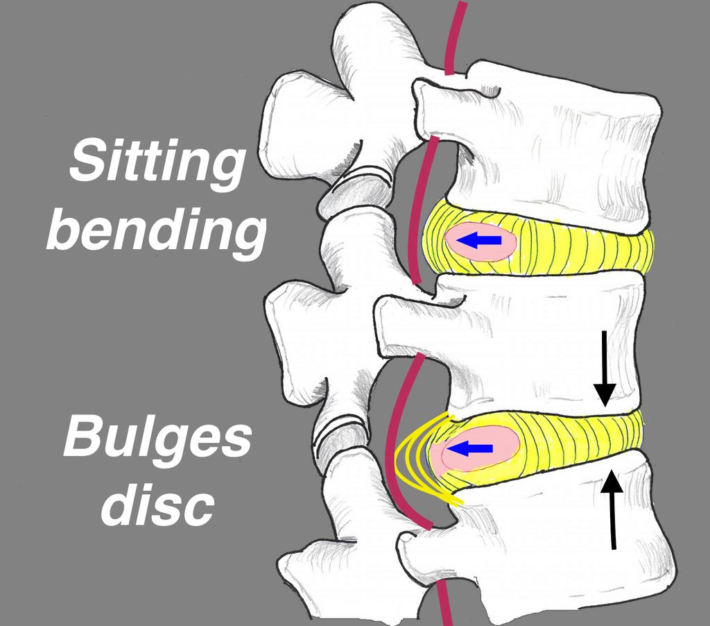 The discs are cushion pads between vertebrae, at the front ¾ of the vertebrae. They are shock absorbers. They also act as ball bearings for vertebrae to pivot on during bending.