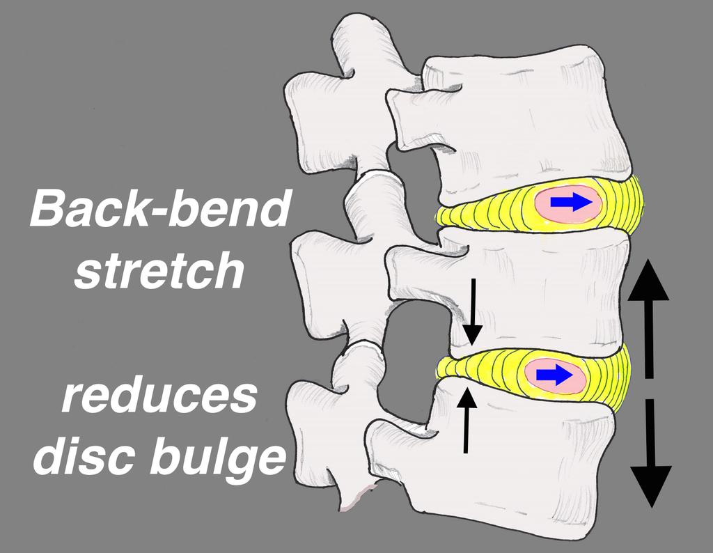They cannot absorb loads or bend as well as before. They get thin from water loss, shifting more load to nearby joints, causing strains and arthritis. As discs thin, bones sit closer together.
