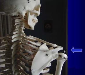 ROTATOR CUFF: Overuse tendinitis at shoulder tendons located between bones of shoulder in