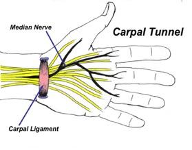 Caused by loading the wrist-hand, where wrist muscles-tendons are supporting the load, hurting up at