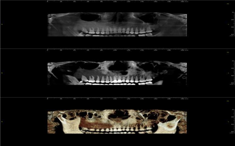 to right maxillary tuberosity area.