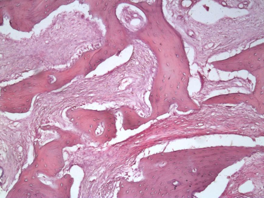 Figure 6. Haematoxylin- and eosin-stained slide showing interconnecting trabeculae of woven bone in a fibroblastic stroma. There is a lack of osteoblastic rimming surrounding the bony trabeculae. III.
