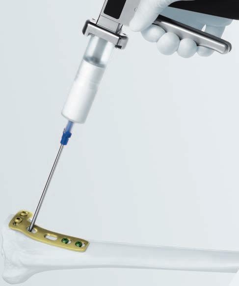 5 Application Warning: A stable internal fixation has to be guaranteed before applying chronos Inject.