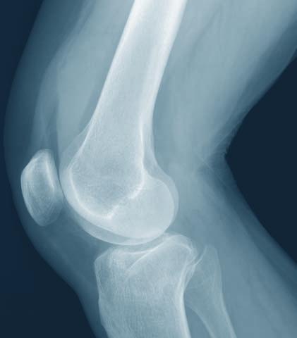 Case Study X-rays of a tibial
