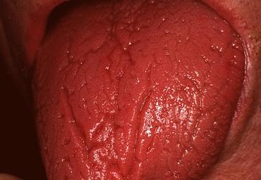 Topographical dermatology Mucosal diseases page: 342 Scrotal / fissured tongue The upper surface of the tongue is criss-crossed by deep grooves running in various