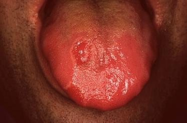 Topographical dermatology Mucosal diseases page: 343 Geographic tongue (benign migratory glossitis) Well-defined patches denuded of papillae, surrounded by an unobtrusive whitish border.