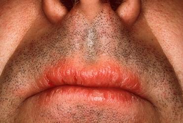 Topographical dermatology Cheilitis page: 345 Cheilitis d by systemic use of isotretinoin Cheilitis d by ingestion of isotretinoin.