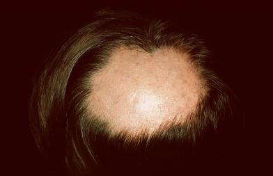 Topographical dermatology Alopecia page: 333 12.