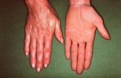 Topographical dermatology Miscellaneous page: 351 Keratoses Hereditary palmoplantar keratoderma (Thost-Unna syndrome) Appearing very early in life (between the 4th and 8th week), this palmoplantar