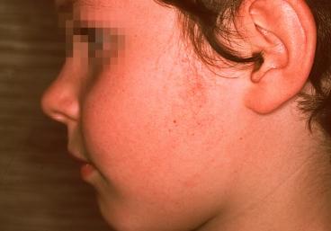 Topographical dermatology Miscellaneous page: 354 Keratosis pilaris Extremely common skin disease surrounded by a fine erythematous border, characterized by slight hyperkeratosis of
