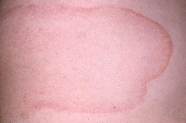 Topographical dermatology Miscellaneous page: 357 Erythema annulare centrifugum (Darier's) continued Among the potential s the following should be remembered: remote infectious foci, viral diseases,