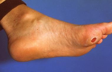 Topographical dermatology Leg ulcers page: 362 Neurotrophic leg ulcer (perforating ulcer) Deep circular, punched-out ulcer found at the bearing surface of the metatarsal joint. The base is necrotic.