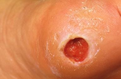 Topographical dermatology Leg ulcers page: 363