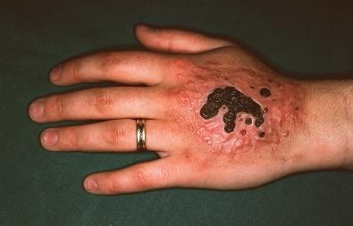 Topographical dermatology Pathomimicry page: 364 12.6 Pathomimicry Skin self-mutilation simulated disease Extensive escharotic ulceration of the back of the hand, d intentionally with caustic soda.