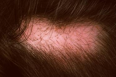 Topographical dermatology Alopecia page: 335 Pseudopelade Pseudopelade consists of circumscribed alopecia which varies in shape and in size, with more or less distinct limits.