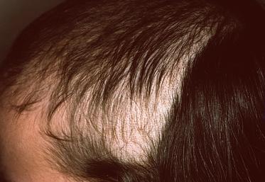 Topographical dermatology Alopecia page: 336 Trichotillomania Plucking of the hair on a large scale.