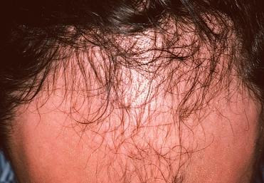 Topographical dermatology Alopecia page: 337 Androgenetic alopecia This alopecia, known generally as baldness, occurs in adulthood both in men, where it affects the temporal regions (photo) and/or