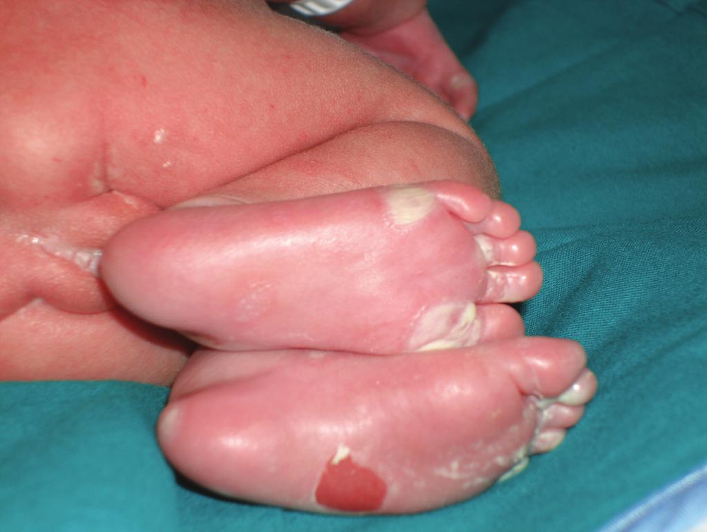 Case Reports in Infectious Diseases 3 Figure 1: Typical blistering skin lesions on the soles of feet in the case described. metaphyseal level (Figure 2).