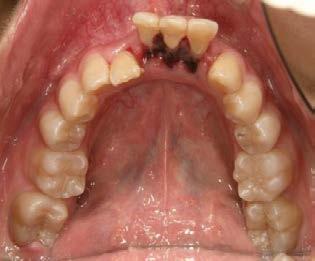 For lingual reduction of the labially displaced mandibular anterior teeth with mobility, careful tooth movement was
