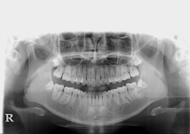 in the maxillary anterior tooth and premolar areas was removed at the same time as the treatment of the mandibular anterior