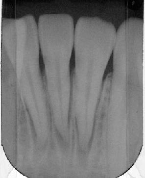 Therefore, we consulted the patient and her parents regarding the extraction of the premolars after reevaluation; however,
