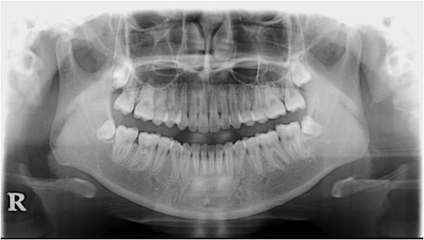 completion. Cephalogram after treatment and overlapping of cephalograms before and after treatment (Figure 11) showed the lingual movement of the mandibular anterior teeth.