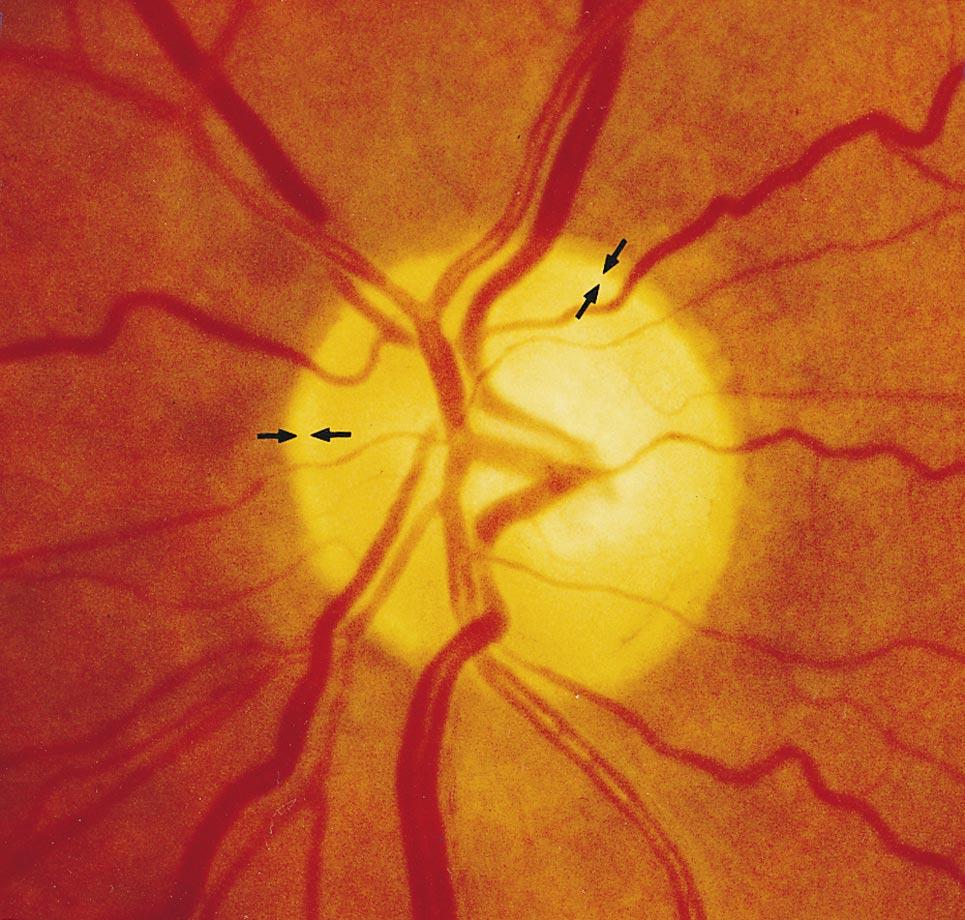 302 Surv Ophthalmol 43 (4) January February 1999 Fig. 10. Medium-sized optic disk with nonglaucomatous optic nerve atrophy.