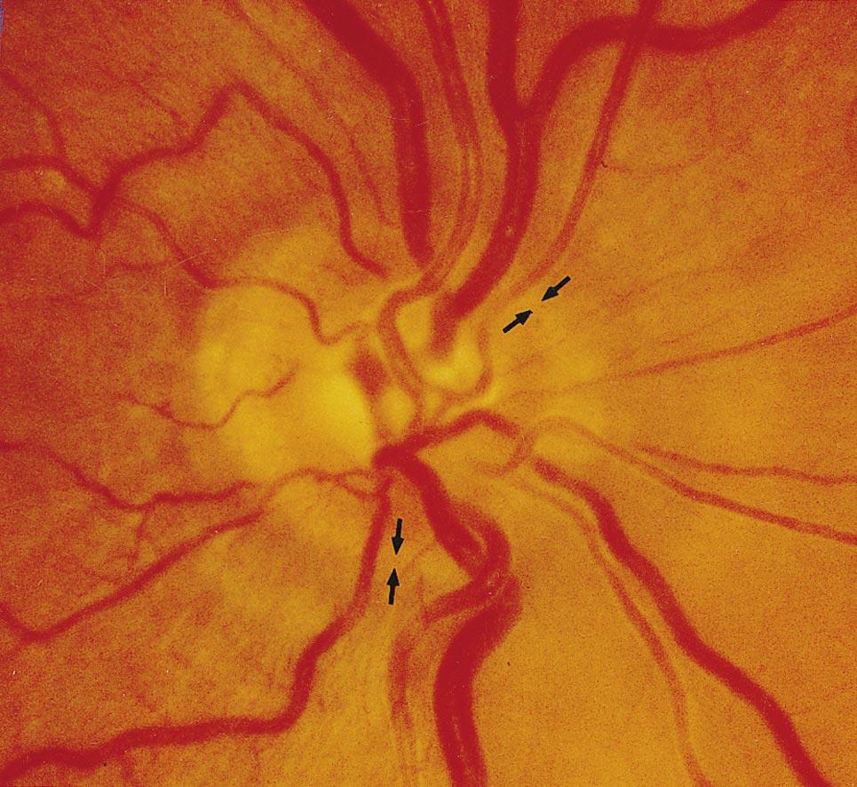 There is no marked parapapillary atrophy, and the visibility of the retinal nerve fiber layer is decreased. The black arrows point toward the peripapillary scleral ring.