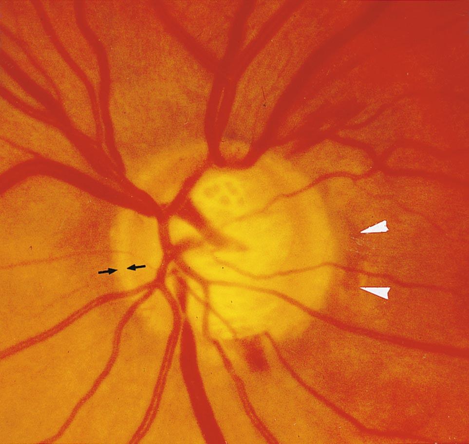 136,152 Accordingly, the neuroretinal rim does not pronouncedly decrease in eyes with JONAS ET AL Fig. 11. Small glaucomatous optic disk: pseudonormal but glaucomatous minicupping in minidisk.