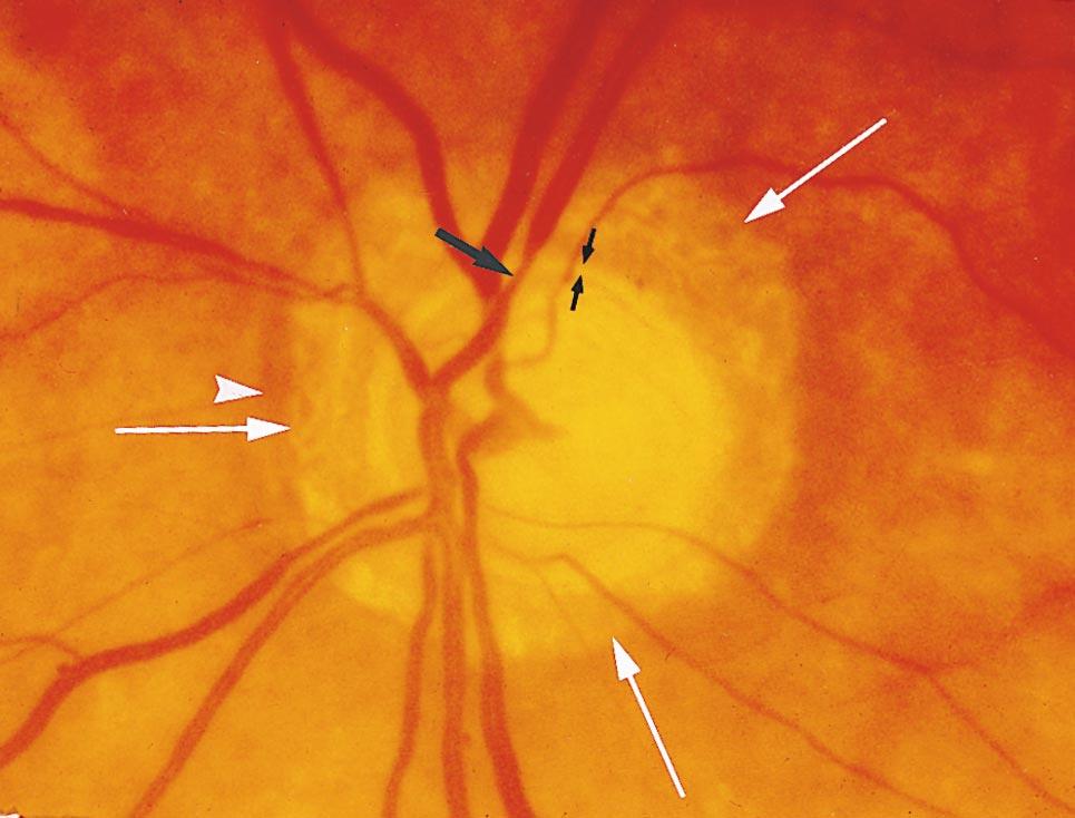 OPHTHALMOSCOPY OF OPTIC NERVE HEAD 307 Fig. 13. Glaucomatous optic disks with parapapillary atrophy: alpha zone (white arrowheads), beta zone (white arrows).