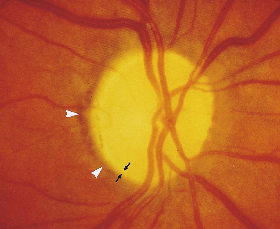 OPHTHALMOSCOPY OF OPTIC NERVE HEAD 309 Fig. 14. Optic disks with nonglaucomatous optic nerve damage: alpha zone of parapapillary atrophy (white arrowheads).