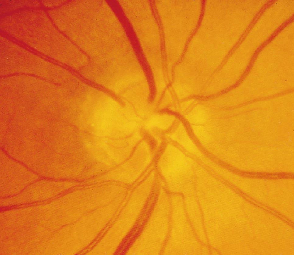 A recent study comparing fundus photographs and fluorescein angiograms with each other showed that focal narrowing of the retinal arterioles in the parapapillary region of eyes with optic