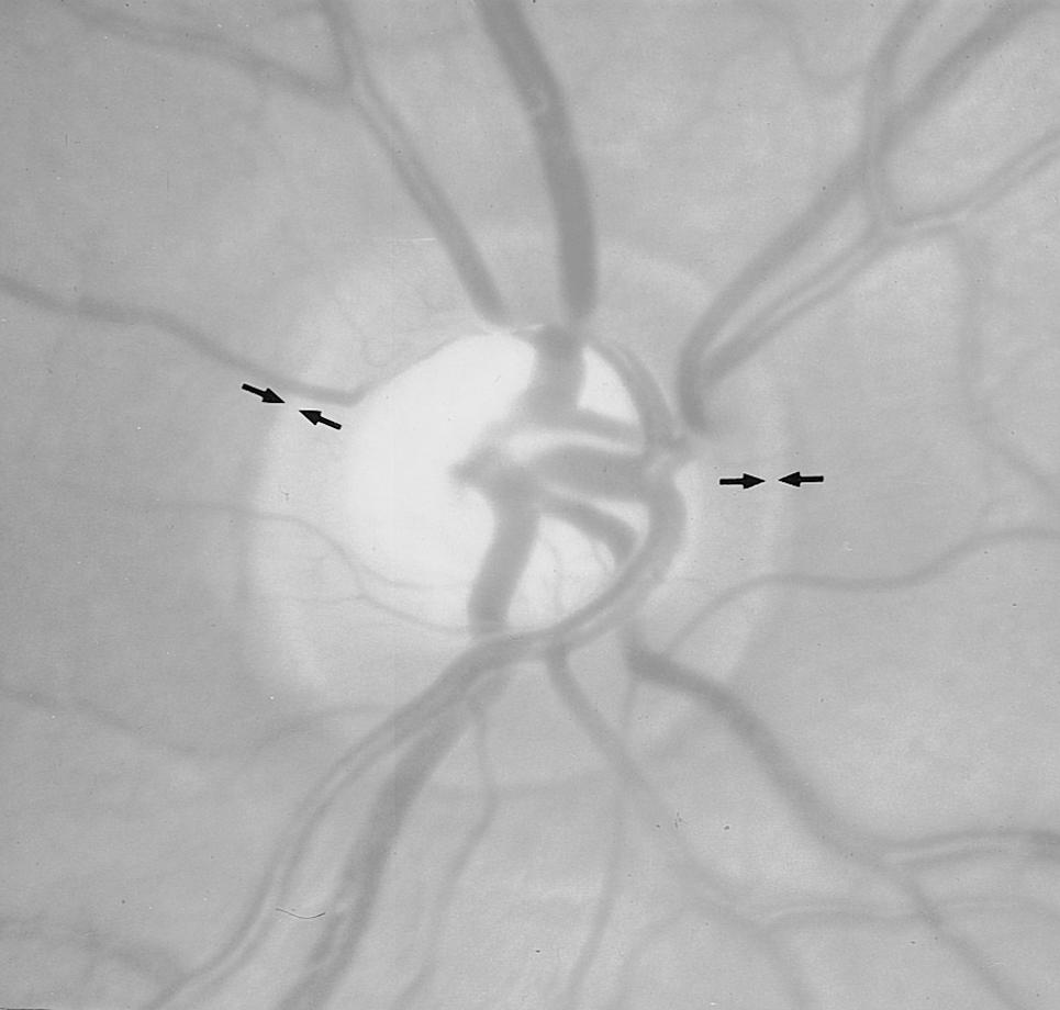 294 Surv Ophthalmol 43 (4) January February 1999 Fig. 1. Small, otherwise normal, optic disk.