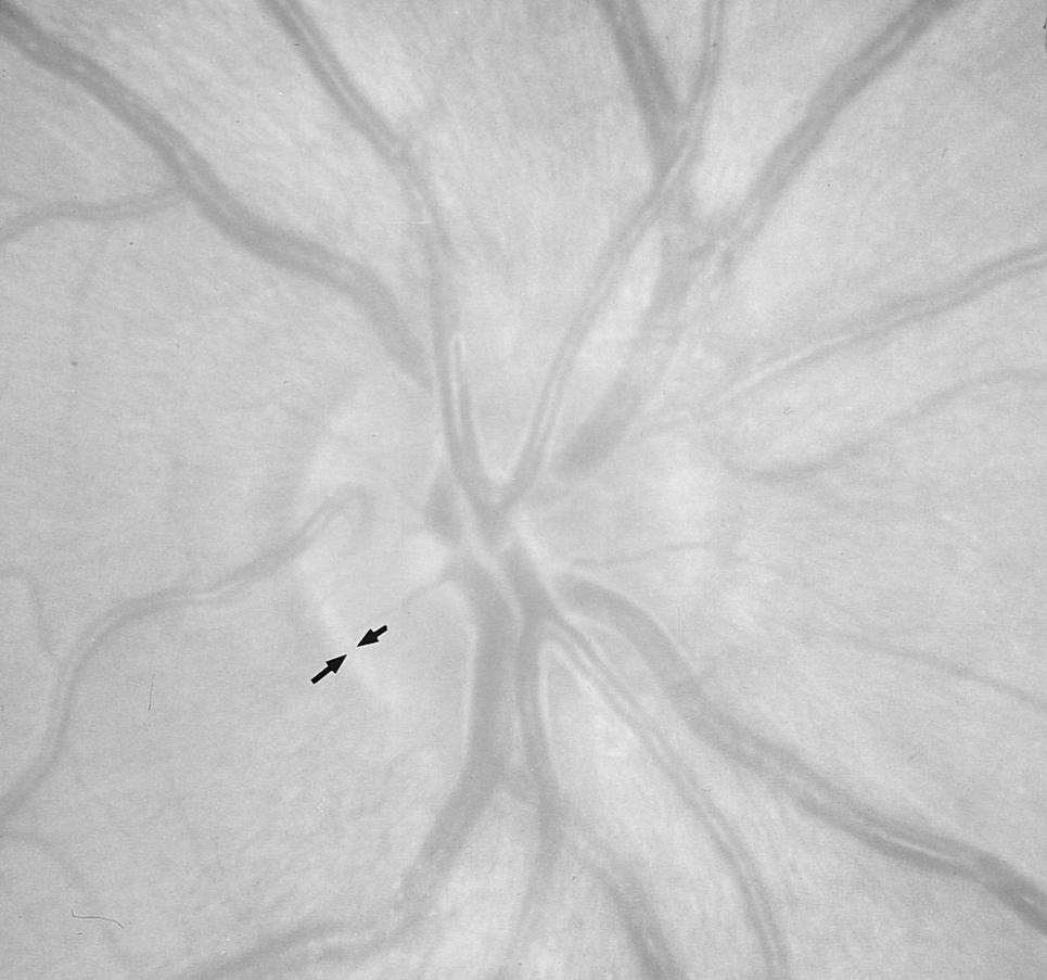 There is no parapapillary atrophy, the diameter of the retinal arterioles is unremarkable, and the visibility of the retinal nerve fiber layer is excellent.