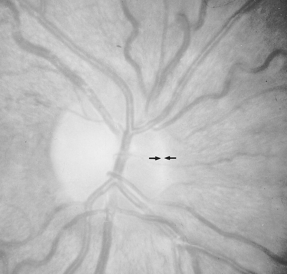 Note the physiologic shape of the neuroretinal rim and the medium size of the optic cup in physiologic relation to the size of the optic disk. The optic cup depth is medium to deep.
