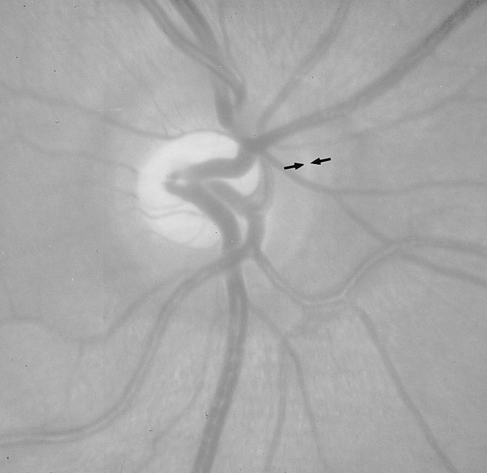 The black arrows point toward the peripapillary scleral ring. JONAS ET AL Fig. 2. Medium-sized normal optic disk with temporal flat sloping of the optic cup.