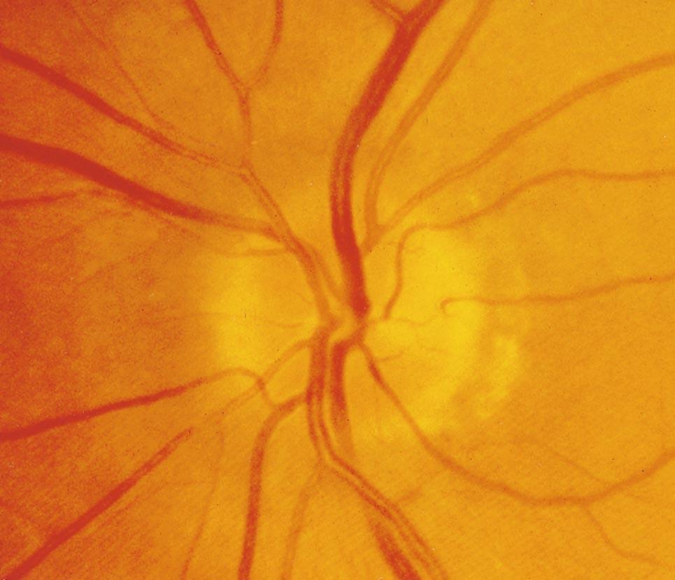 the retinal nerve fiber layer in a minidisk with reduced caliber of the retinal arterioles. 2.