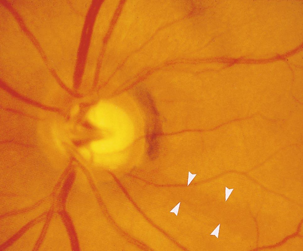 After sectioning of the optic nerve in the orbit of monkeys, Quigley 214 observed loss of the visibility of the RNFL starting 1 month after the operation and complete 4 weeks later.