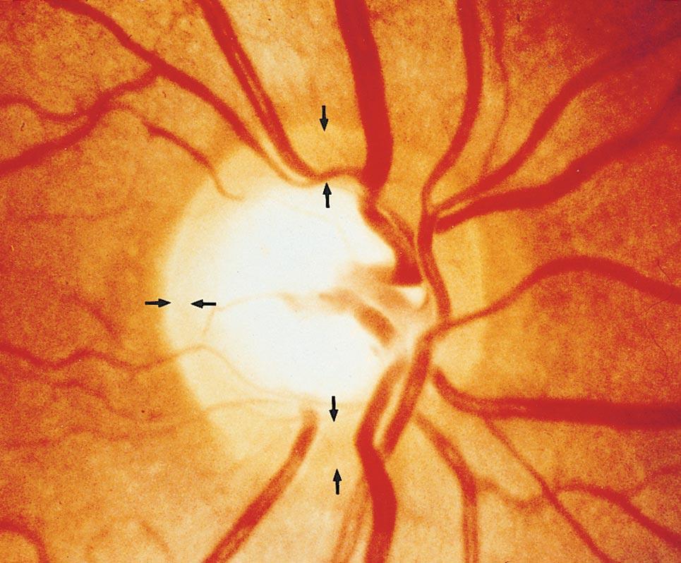 138,139,147 If the RNFL is markedly more detectable in the temporal superior fundus region than in the temporal inferior sector in an eye without fundus irregularities, it points toward a loss of