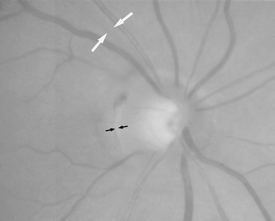 300 Surv Ophthalmol 43 (4) January February 1999 JONAS ET AL Fig. 8. Glaucomatous optic disks with abnormal shape of the neuroretinal rim.