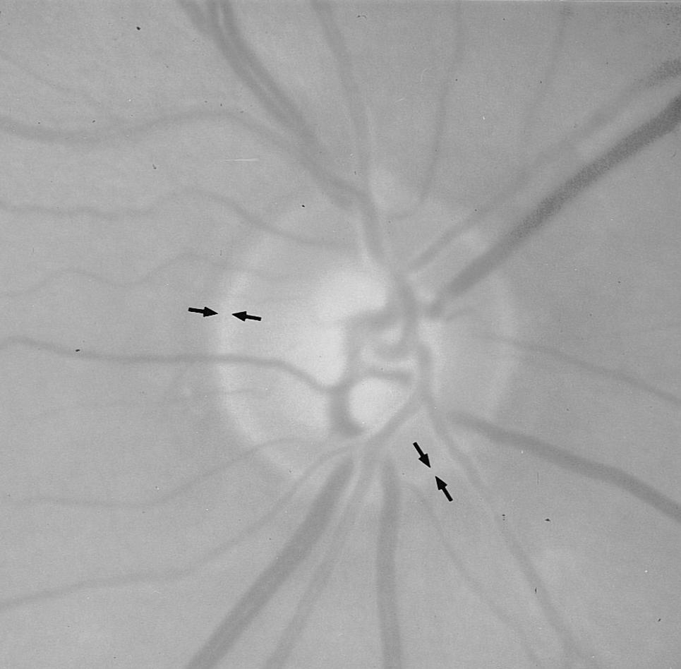 The long white arrows in the top left photograph point toward the localized retinal nerve fiber layer defect. The black arrows point toward the peripapillary scleral ring. 5.