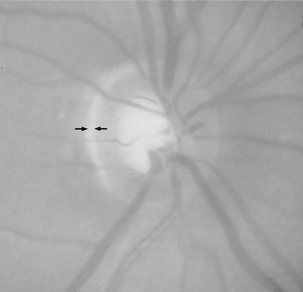 Thin nerve fibers come from the foveola, passing mainly through the temporal aspect of the optic disk,131,148,180,190,191,221 and are less susceptible to glaucoma218 than thick nerve fibers, which