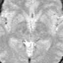Fig.4 Fig.4: Subimages (55x55 mm FOV) of the brain stem., xial section at the level of the upper midbrain.