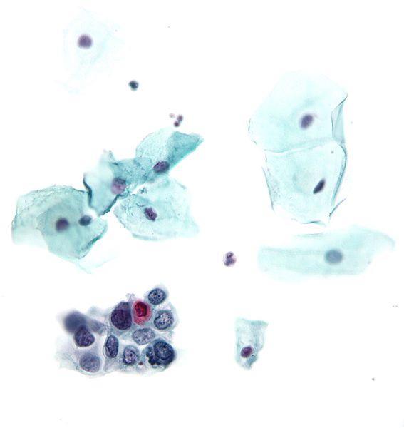 Papanicolaou test (Pap test or smear) used to detect