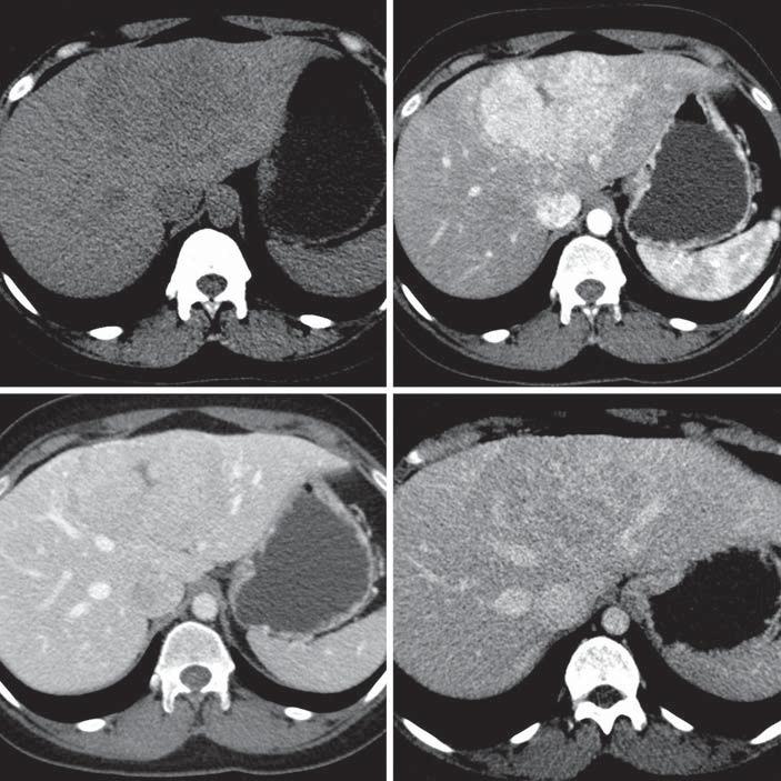 Fig. 1. Multiphse CT scn of typicl FNH. On plin CT: slightly hypodense lesion is visible in liver segment 4 ( ).