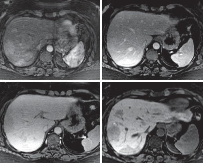 In the heptobiliry phse, the lesion is still hyperintense compred to the norml liver tissue ( d ). c b d b Fig. 5. MRI with heptobiliry contrst gent of typicl HCA.